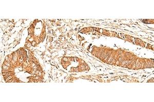 Immunohistochemistry of paraffin-embedded Human colorectal cancer tissue using BAG3 Polyclonal Antibody at dilution of 1:35(x200) (BAG3 Antikörper)