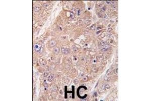 Formalin-fixed and paraffin-embedded human hepatocarcinoma tissue reacted with hUVRAG (Center) (ABIN388587 and ABIN2849985) , which was peroxidase-conjugated to the secondary antibody, followed by DAB staining. (UVRAG Antikörper  (AA 366-398))