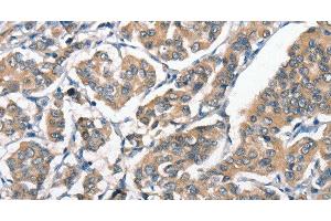 Immunohistochemistry of paraffin-embedded Human breast cancer tissue using HGF Polyclonal Antibody at dilution 1:65 (HGF Antikörper)