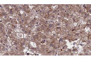 ABIN6273967 at 1/100 staining Human liver cancer tissue by IHC-P. (OR1G1 Antikörper  (Internal Region))