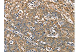 The image on the left is immunohistochemistry of paraffin-embedded Human gastric cancer tissue using ABIN7190368(CSMD1 Antibody) at dilution 1/40, on the right is treated with synthetic peptide.