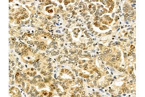 ABIN6259505 and ABIN6275797 at 1/100 staining Human kidney cancer by IHC-P. (CHFR Antikörper  (Internal Region))