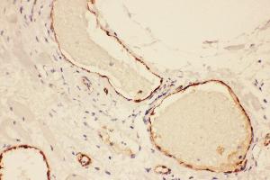 Anti-VWF Picoband antibody,  IHC(P): Human Lung Cancer Tissue (VWF Antikörper  (AA 2535-2813))