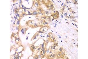 Immunohistochemistry of paraffin-embedded Human liver cancer using ACADS Polyclonal Antibody at dilution of 1:100 (40x lens). (ACADS Antikörper)