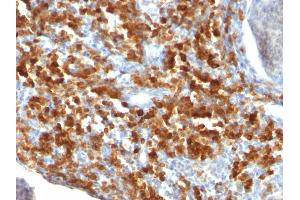 Formalin-fixed, paraffin-embedded human Lymphoma stained with CD79a Monoclonal Antibody (IGA/515). (CD79a Antikörper)