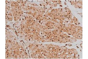 ABIN6267363 at 1/200 staining Human bladder cancer tissue sections by IHC-P.