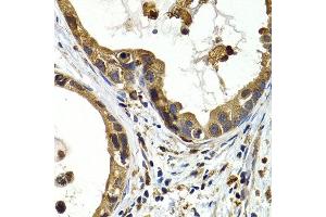 Immunohistochemistry of paraffin-embedded human stomach cancer using CTSS antibody at dilution of 1:200 (400x lens). (Cathepsin S Antikörper)