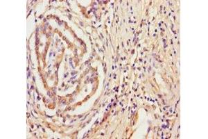 Immunohistochemistry of paraffin-embedded human pancreatic cancer using ABIN7166456 at dilution of 1:100 (TPST2 Antikörper  (AA 26-377))