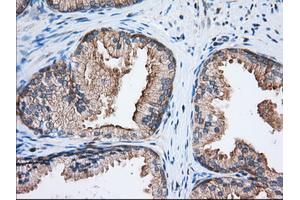Immunohistochemical staining of paraffin-embedded Adenocarcinoma of Human ovary tissue using anti-EIF2S1 mouse monoclonal antibody. (EIF2S1 Antikörper)