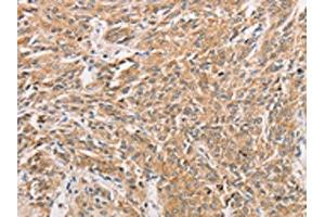 The image on the left is immunohistochemistry of paraffin-embedded Human prostate cancer tissue using ABIN7131608(WNT11 Antibody) at dilution 1/20, on the right is treated with fusion protein. (WNT11 Antikörper)