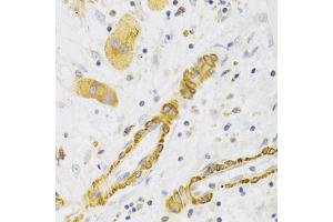 Immunohistochemistry of paraffin-embedded human liver cancer using KIF1B Antibody (ABIN5973994) at dilution of 1/100 (40x lens). (KIF1B Antikörper)