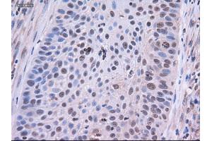 Immunohistochemical staining of paraffin-embedded Adenocarcinoma of colon using anti-EpCAM (ABIN2452541) mouse monoclonal antibody. (EpCAM Antikörper  (AA 24-265))