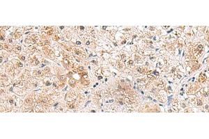 Immunohistochemistry of paraffin-embedded Human liver cancer tissue using RTKN2 Polyclonal Antibody at dilution of 1:75(x200) (RTKN2 Antikörper)