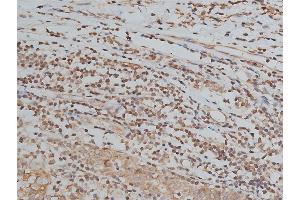 ABIN6267039 at 1/200 staining human breast cancer tissue sections by IHC-P. (Histone 3 Antikörper)
