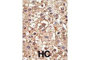 Formalin-fixed and paraffin-embedded human hepatocellular carcinoma tissue reacted with the PIAS4 polyclonal antibody  , which was peroxidase-conjugated to the secondary antibody, followed by DAB staining. (PIAS4 Antikörper  (N-Term))