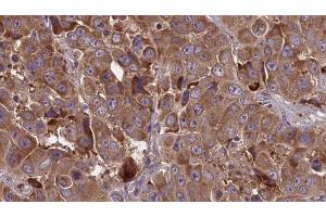 ABIN6273847 at 1/100 staining Human liver cancer tissue by IHC-P. (OR51J1 Antikörper)
