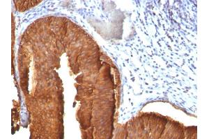 Formalin-fixed, paraffin-embedded human Bladder Carcinoma stained with Cytokeratin 19 Mouse Monoclonal Antibody (KRT19/800). (Cytokeratin 19 Antikörper)