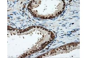 Immunohistochemical staining of paraffin-embedded Carcinoma of liver tissue using anti-LIPG mouse monoclonal antibody. (LIPG Antikörper)