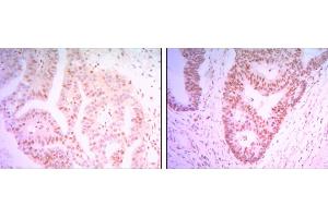 Immunohistochemical analysis of paraffin-embedded colon cancer tissues (left) and ovary cancer tissues (right) using THAP11 mouse mAb with DAB staining. (THAP11 Antikörper)