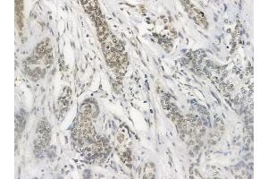 ABIN6257411 and ABIN6274478 at 1/100 staining human breast carcinoma by IHC-P. (PKNOX2 Antikörper  (C-Term))