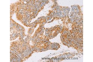 Immunohistochemistry of Human lung cancer using YARS2 Polyclonal Antibody at dilution of 1:30 (YARS2 Antikörper)