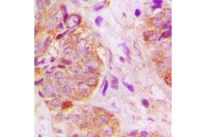 Immunohistochemical analysis of GSPT1 staining in human breast cancer formalin fixed paraffin embedded tissue section.