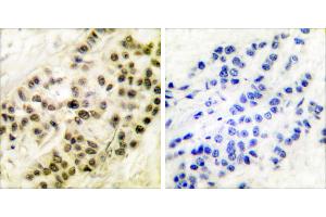 Peptide - +Immunohistochemical analysis of paraffin-embedded human breast carcinoma tissue using Cyclin B1 (Ab-126) antibody (#BOO68). (Cyclin B1 Antikörper  (Ser126))