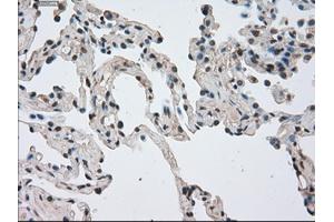 Immunohistochemical staining of paraffin-embedded Adenocarcinoma of breast tissue using anti-NEK6 mouse monoclonal antibody. (NEK6 Antikörper)