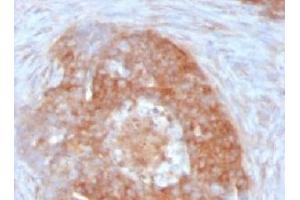 Formalin-fixed, paraffin-embedded human ovarian carcinoma stained with Fascin antibody (FSCN1/417) (Fascin Antikörper)