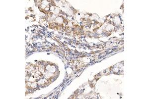 Immunohistochemistry of paraffin-embedded human lung cancer using Sterol carrier protein 2 Rabbit mAb (ABIN7270597) at dilution of 1:100 (40x lens). (SCP2 Antikörper)