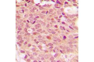 Immunohistochemical analysis of Histone Deacetylase 5 (pS498) staining in human breast cancer formalin fixed paraffin embedded tissue section. (HDAC5 Antikörper  (pSer498))