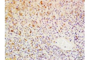 Formalin-fixed and paraffin embedded human glioma tissue labeled with Anti-WIG-1/PAG608 Polyclonal Antibody, Unconjugated  at 1:200, followed by conjugation to the secondary antibody and DAB staining (ZMAT3 Antikörper  (AA 201-288))