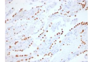 Formalin-fixed, paraffin-embedded human Lung Adenocarcinoma stained with TTF-1 Rabbit Recombinant Monoclonal Antibody (NX2. (Rekombinanter NKX2-1 Antikörper)