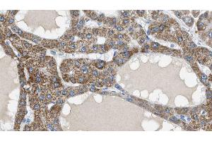 ABIN6269118 at 1/100 staining Human liver cancer tissue by IHC-P. (IGF1R Antikörper  (C-Term))