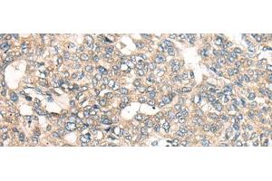Immunohistochemistry of paraffin-embedded Human liver cancer tissue using LRP1B Polyclonal Antibody at dilution of 1:50(x200) (LRP1B Antikörper)