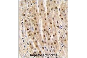 Formalin-fixed and paraffin-embedded human hepatocarcinoma tissue reacted with GDH antibody (N-term), which was peroxidase-conjugated to the secondary antibody, followed by DAB staining. (GAPDH Antikörper  (N-Term))