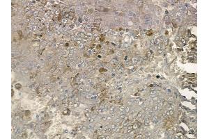 ABIN6255714 and ABIN6267195 at 1/100 staining human melanoma by IHC-P.