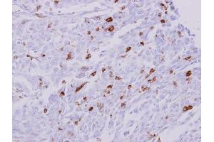 IHC-P Image HLA-DRA antibody detects HLA-DRA protein at membrane on human Leukocytes in liver carcinoma by immunohistochemical analysis. (HLA-DRA Antikörper)