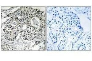Immunohistochemistry analysis of paraffin-embedded human breast carcinoma tissue using PXMP2 antibody. (PXMP2 Antikörper)