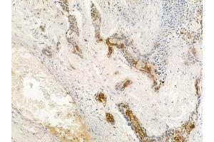 ABIN6262776 and ABIN6266570 at 1/100 staining human breast carcinoma by IHC-P. (KRT17 Antikörper  (C-Term))