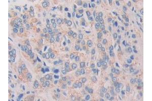 IHC-P analysis of Human Prostate cancer Tissue, with DAB staining.