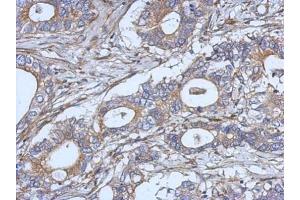 IHC-P Image Immunohistochemical analysis of paraffin-embedded human gastric cancer, using IL2, antibody at 1:500 dilution. (IL-2 Antikörper)
