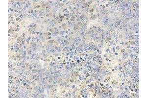 ABIN6256653 and ABIN6267393 at 1/100 staining human melanoma by IHC-P. (VAV1 Antikörper  (pTyr174))