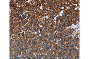 Immunohistochemistry of Human cervical cancer using FCGR3A Polyclonal Antibody at dilution of 1:40 (FCGR3A Antikörper)