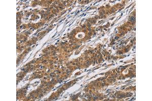 Immunohistochemistry of Human thyroid cancer using CYP21A2 Polyclonal Antibody at dilution of 1:60