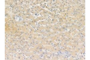 ABIN6257348 and ABIN6274717 at 1/100 staining human hepatocellular carcinoma by IHC-P. (MRPS12 Antikörper  (Internal Region))
