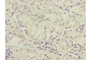 Immunohistochemistry of paraffin-embedded human gastric cancer using ABIN7170271 at dilution of 1:100 (GPR172B Antikörper  (AA 212-279))