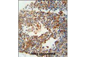 OR9Q1 antibody immunohistochemistry analysis in formalin fixed and paraffin embedded human lung carcinoma followed by peroxidase conjugation of the secondary antibody and DAB staining. (OR9Q1 Antikörper  (C-Term))