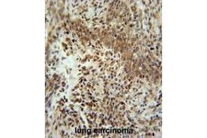 ZNF667 Antibody (Center) immunohistochemistry analysis in formalin fixed and paraffin embedded human lung carcinoma followed by peroxidase conjugation of the secondary antibody and DAB staining. (ZNF667 Antikörper  (Middle Region))