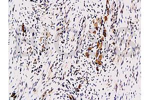 Formalin-fixed and paraffin embedded human colon carcinoma with Anti-Maspin Polyclonal Antibody, Unconjugated (ABIN728233) at 1:200, followed by conjugation to the secondary antibody and DAB staining (SERPINB5 Antikörper  (AA 301-375))